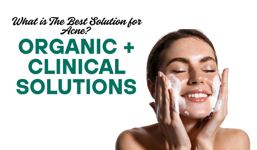 What is The Best Solution for Acne? Organic + Clinical Solutions