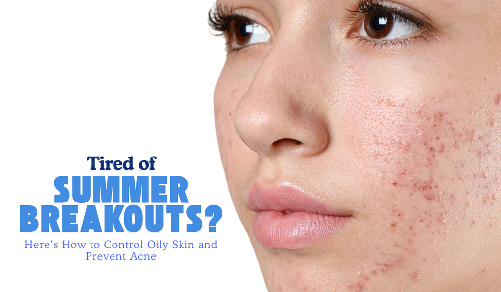 Tired of Summer Breakouts? Here’s How to Control Oily Skin and Prevent Acne