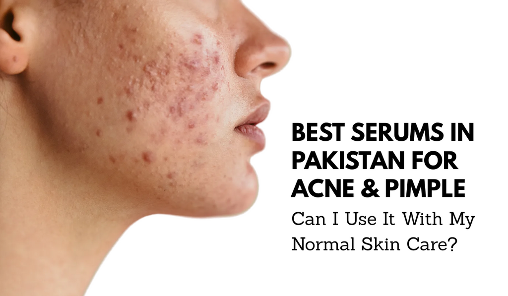 Best Serums in Pakistan for Acne & Pimple - Can I Use It With My Normal Skin Care?