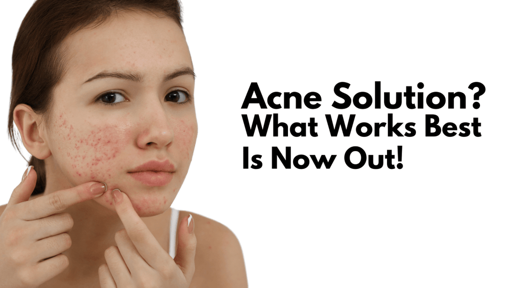 How Salicylic Acid and Niacinamide Work Better Together for Acne - Beautenic
