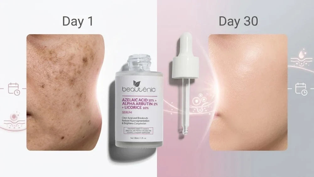I Used Azelaic Acid Serum for 30 Days! Here's What Really Happened to My Hyperpigmentation