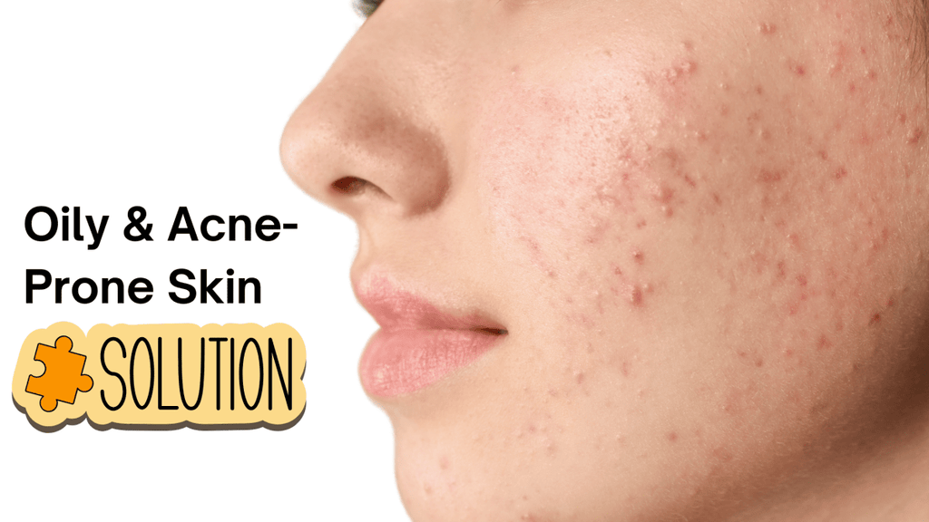 Your Guide to Managing Oily & Acne-Prone Skin this 2025 Summer - Beautenic