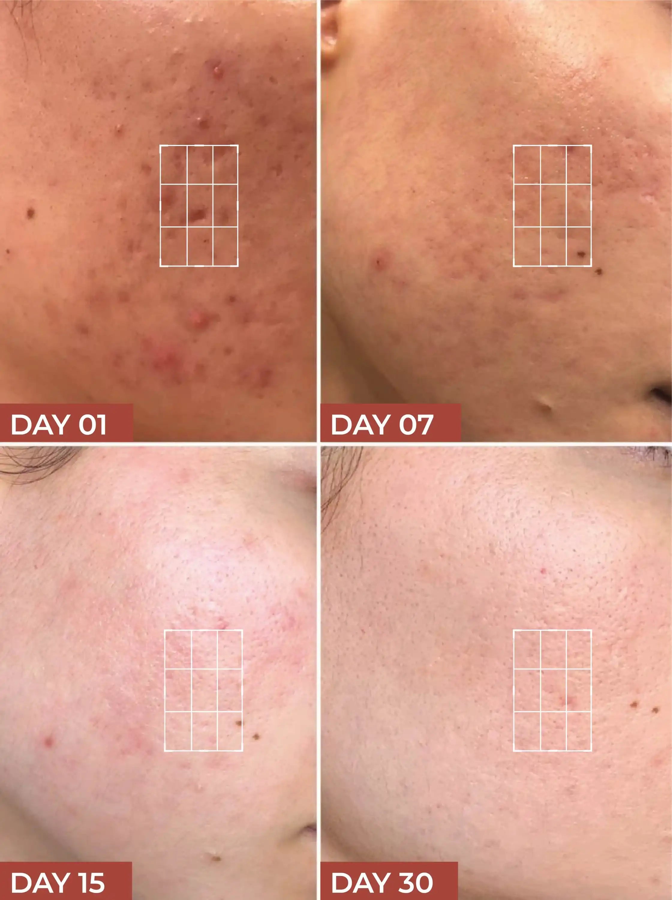 Acne Scar Treatment Gel