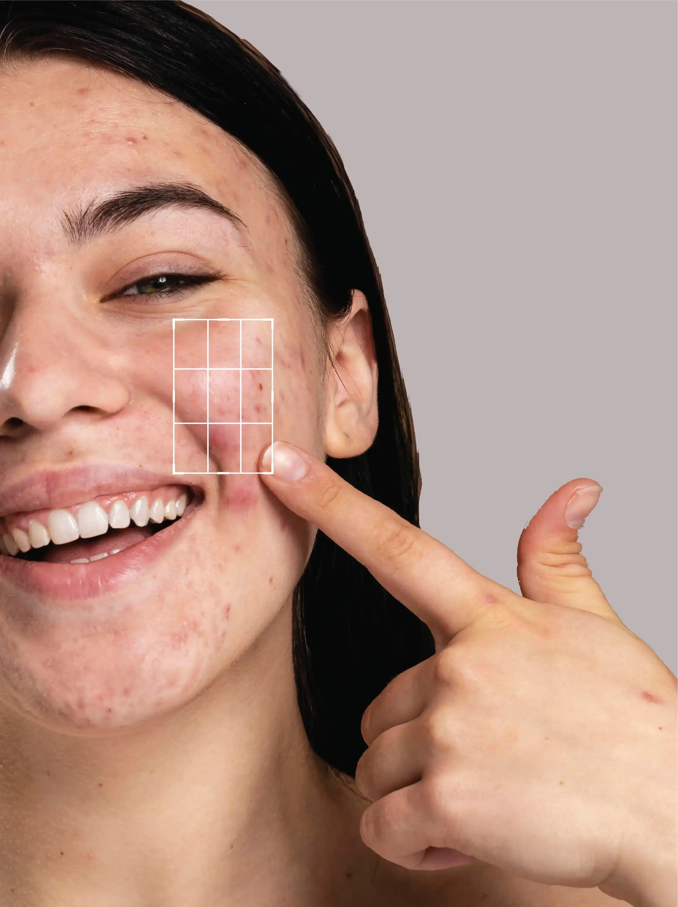 Antibacterial Acne Cream