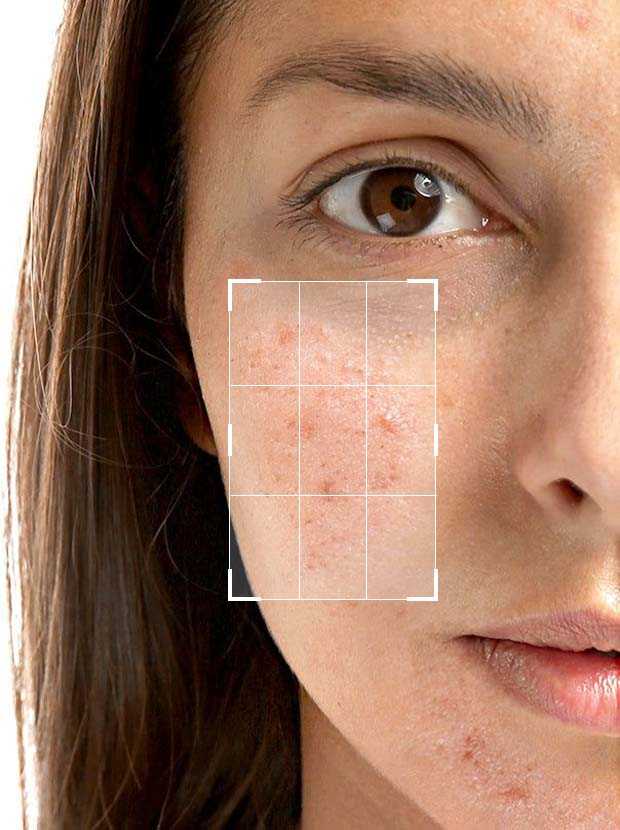 Azelaic Acid 10% + Alpha Arbutin 2% + Licorice 10% Serum