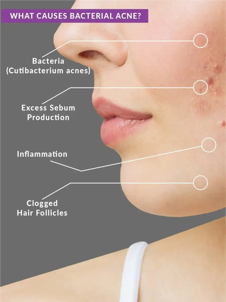 Benzoyl Peroxide 2.5% Acne Treatment Toner