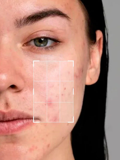 Acne and Blemishes