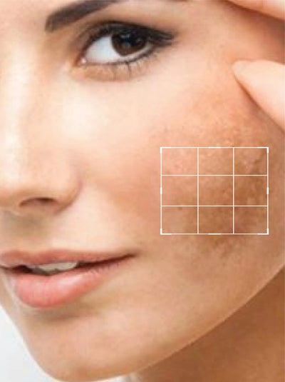 Brightening and Hyperpigmentation