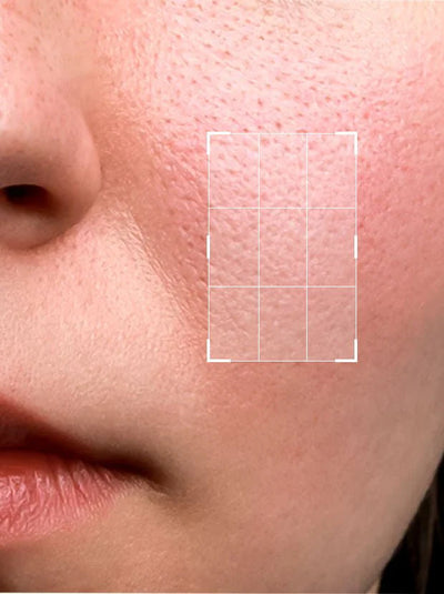 Enlarged Pores & Textured Skin
